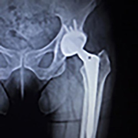 Upper hip xray